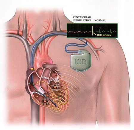 defibrilljator